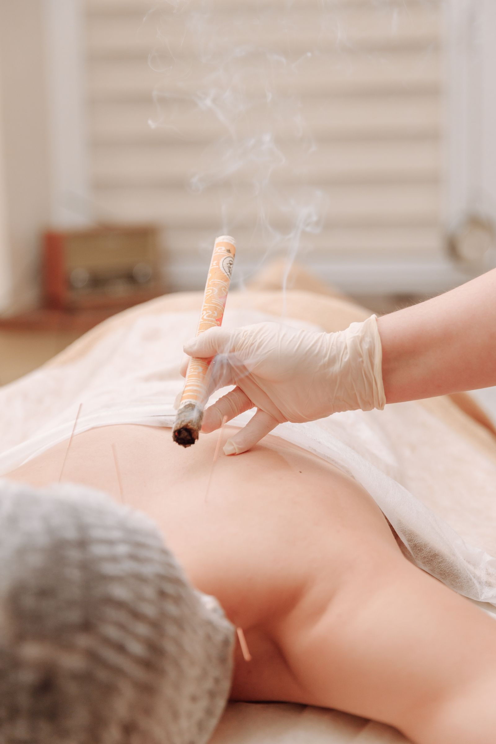 Terapeutka v rukaviciach drží zapálenú moxa cigaru nad chrbtom pacienta